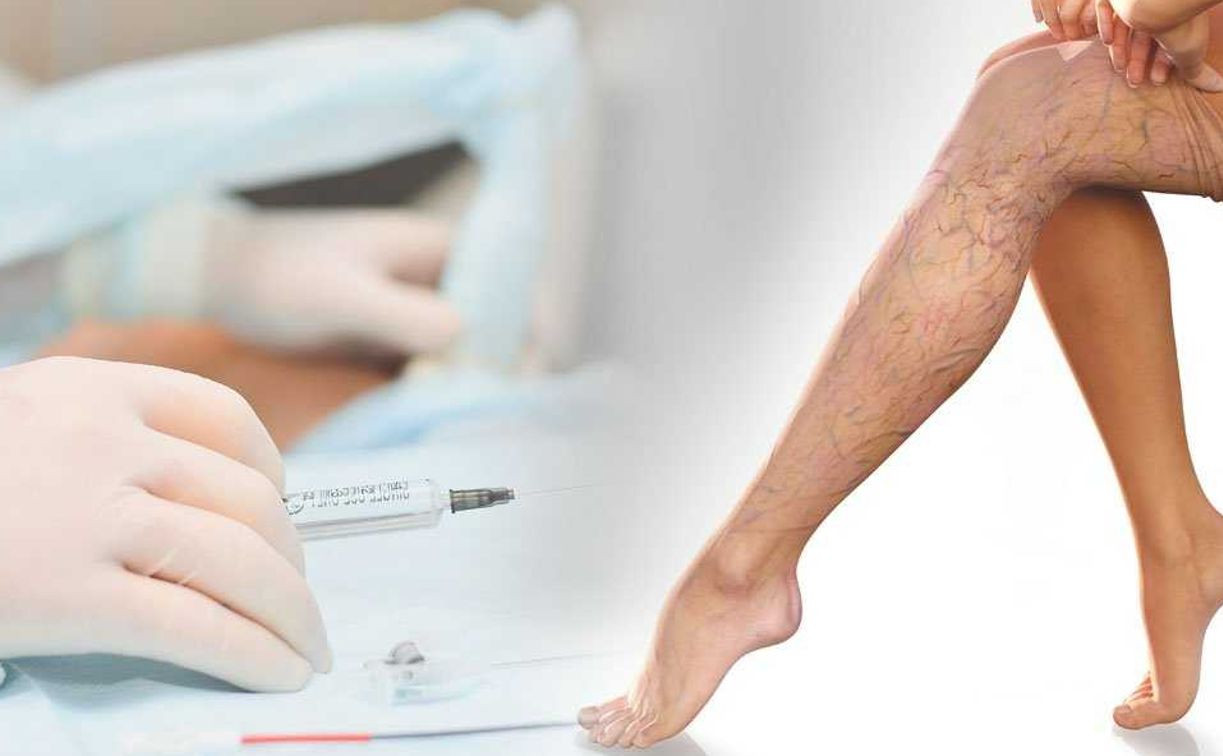 Врач по поводу ног. Трофическая язва голени клиника. Варикозное расширение вен нижних конечностей клиника. Варикозное расширение вен нижних конечностей склеротерапия.