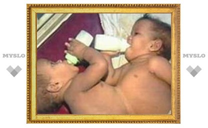 В Индии разделили 10-месячных сиамских близнецов
